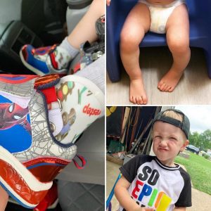 a toddler with one foot that turns in so he wears SMO braces to straighten it 