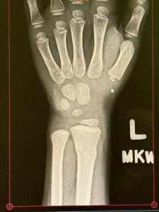 x-ray image of a buckle fracture in a 6 year old boys wrist.