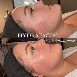 a close up of a woman as a before and after shot of a facial for love your skin day