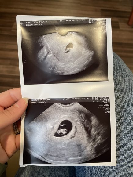 a close up of a mom holding an ultrasound photo for a high risk pregnancy